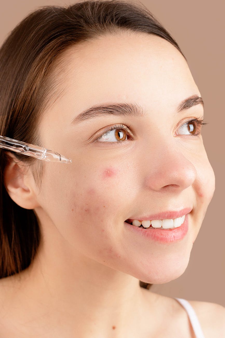 Como Tratar a Acne Adulta com Dicas Práticas